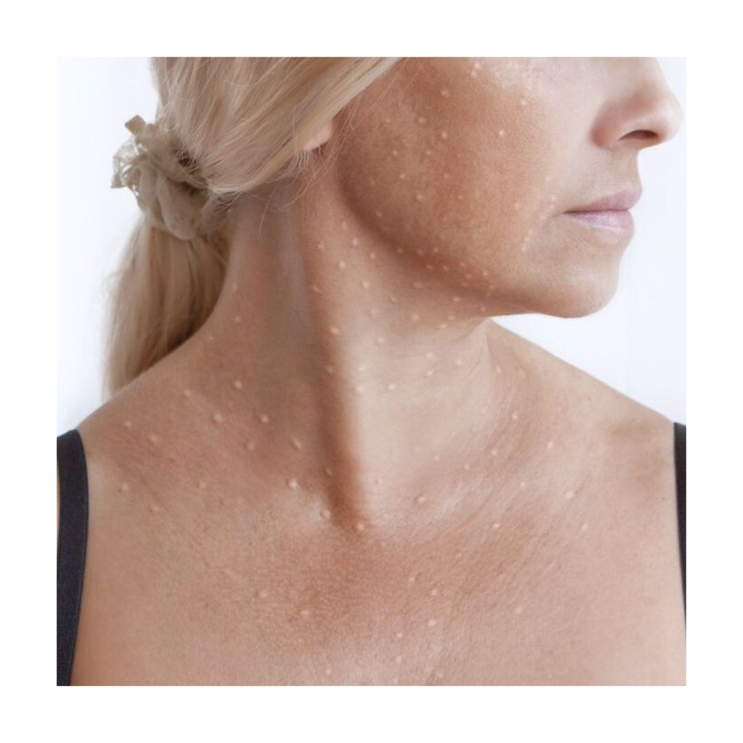 Mezoterapia igłowa na twarzy, szyji i dekoltu w gabinecie EmiSkin w Oleśnicy