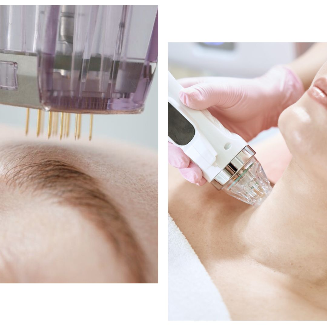 Zabieg radiofrekwencji mikroigłowej twarzy w gabinecie kosmetologicznym EmiSkin w Oleśnicy